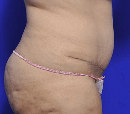 Tummy tuck surgery 03, after photo