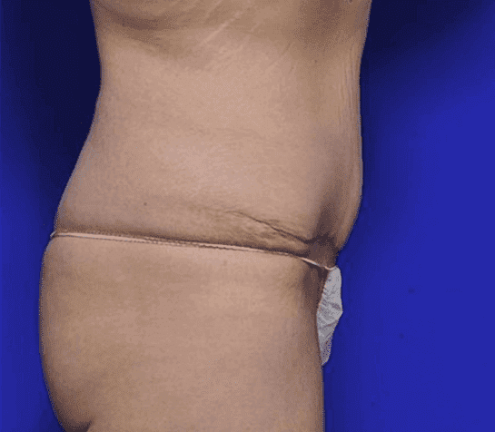 Tummy tuck patient, Dr Ritz, photo 06, after procedure