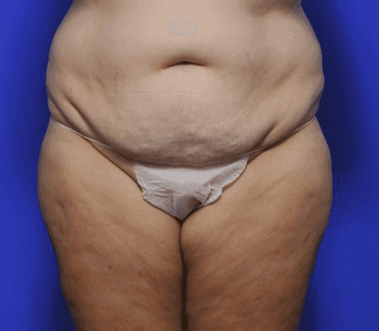 Tummy tuck, patient before surgery 07
