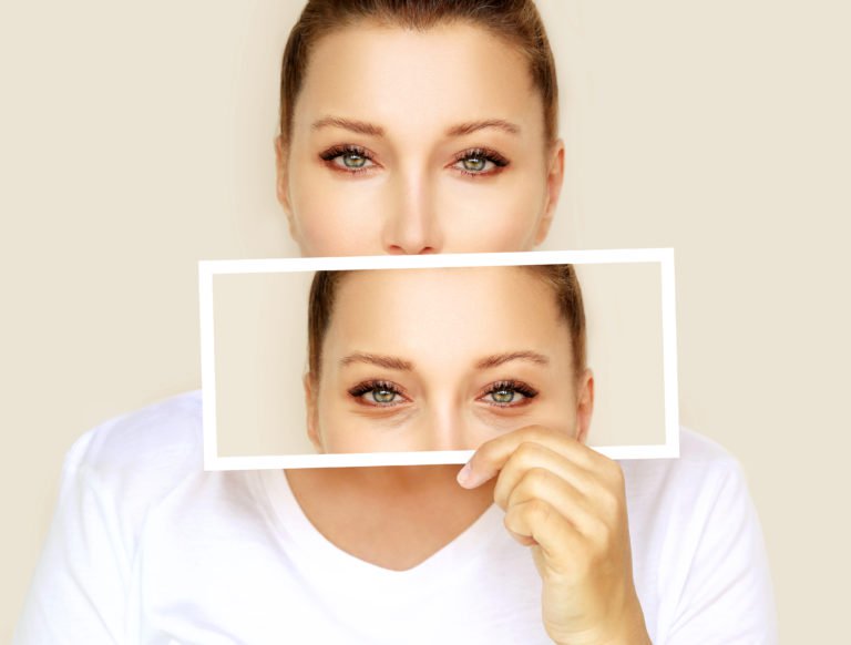 eyelid surgery - blepharoplasty image