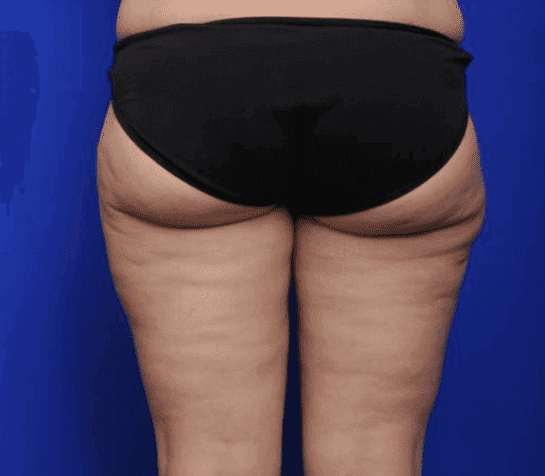 Body lift at Ritz Plastic Surgery, patient after surgery, photo 05