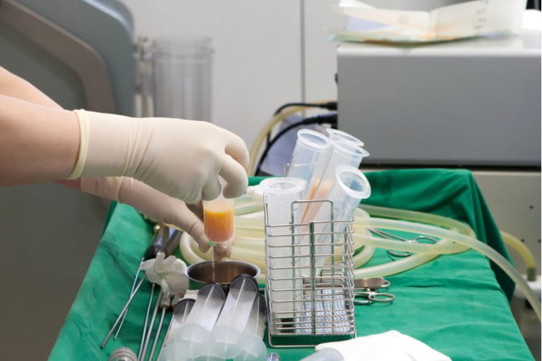 Fat transfer procedure at Dr Ritz clinic