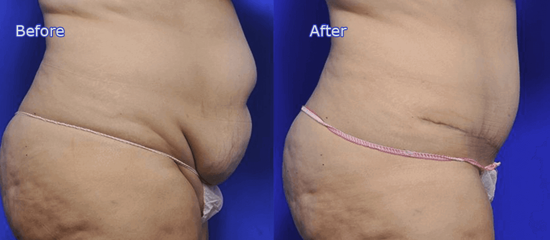 Tummy tuck before and after image 3a, Ritz Plastic Surgery Melbourne