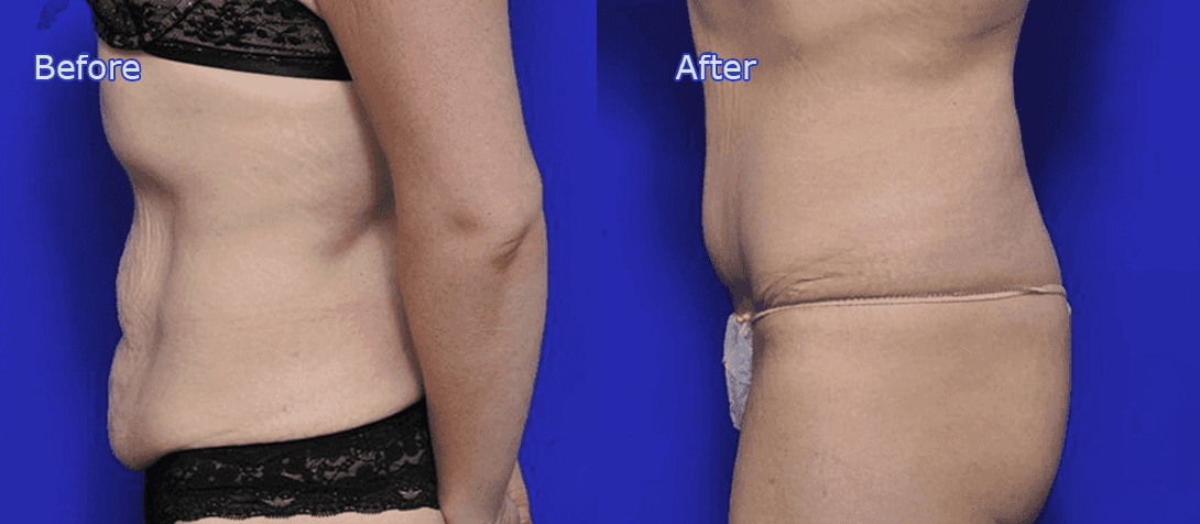 Tummy tuck, before and after, photo 5a