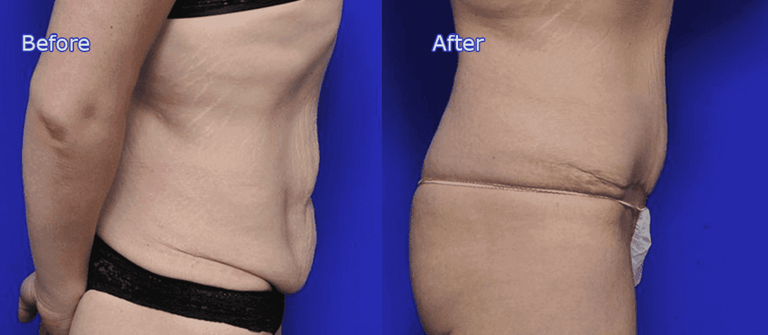 Tummy Tuck (abdominoplasty) before and after photo 6a