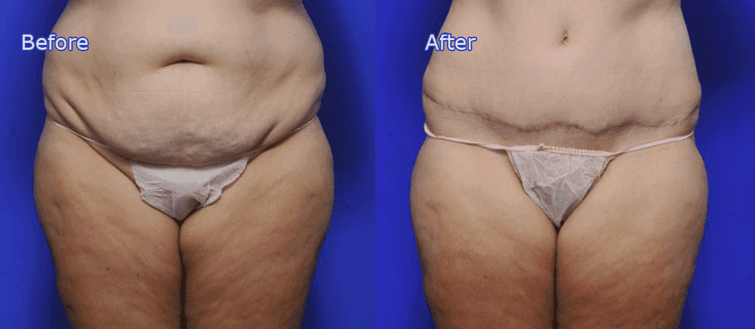 Tummy tuck before and after image 7a