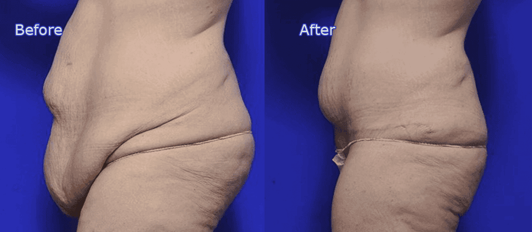 Body lift surgery, patient before & after 2a, side view