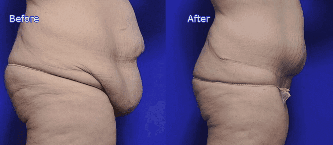A patient before and after body lift 3a, Dr Ritz