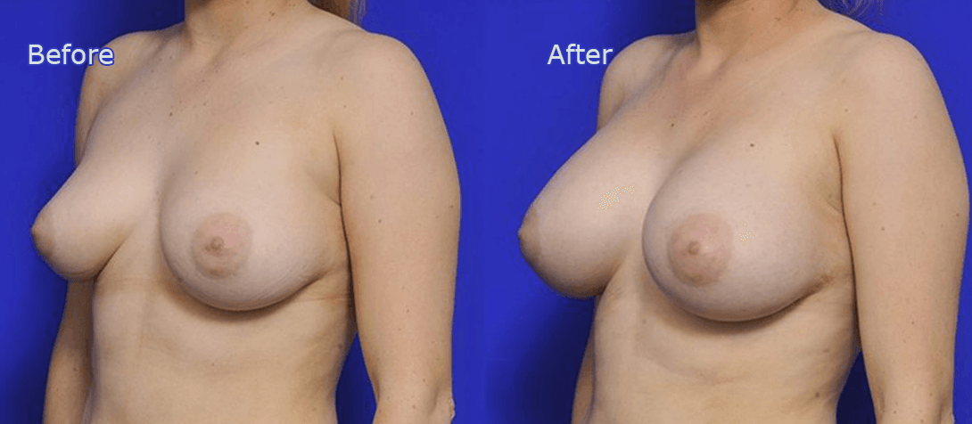 Breast augmentation surgery before and after 10a, angle view