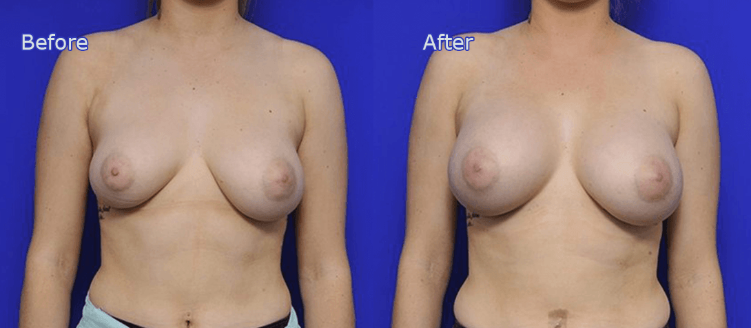 Breast enhancement before and after 11a