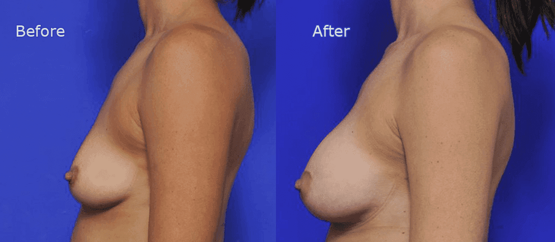 Breast augmentation patient photo 19a, left side view