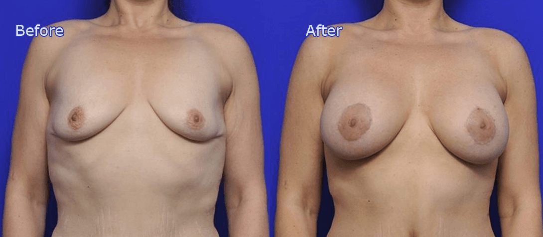 Breast augmentation with implants before and after 05a
