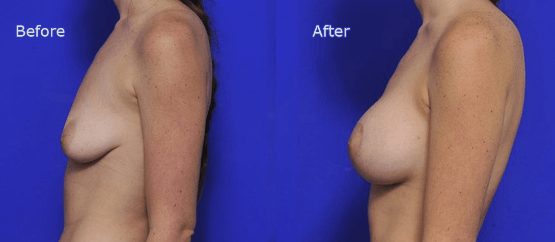 Breast augmentation 07a, left side photo