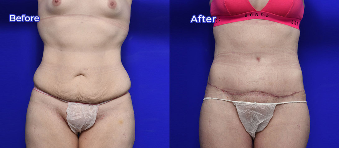 Tummy tuck patient BA 01, Dr Ritz