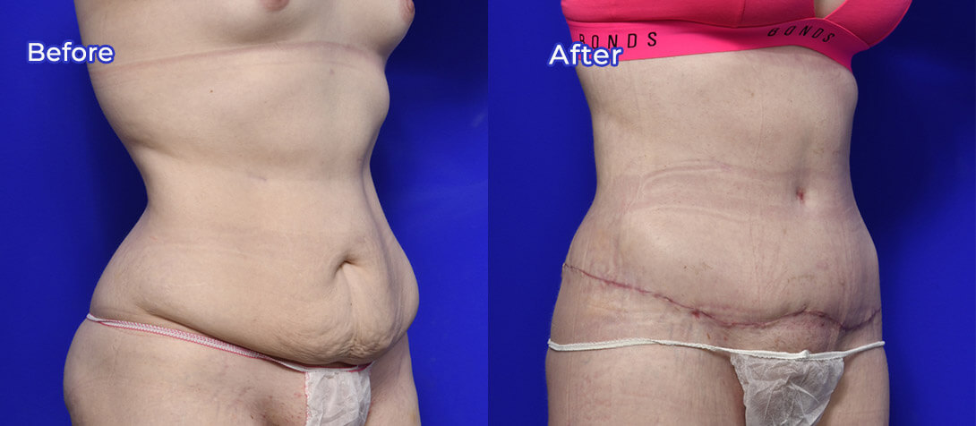 Abdominoplasty photo 02, Dr Morris Ritz