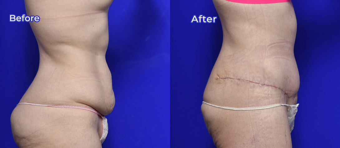 Tummy tuck patient 04, Ritz Plastic Surgery