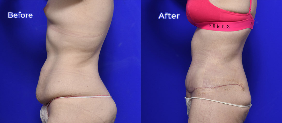 Abdominoplasty patient, before and after 05