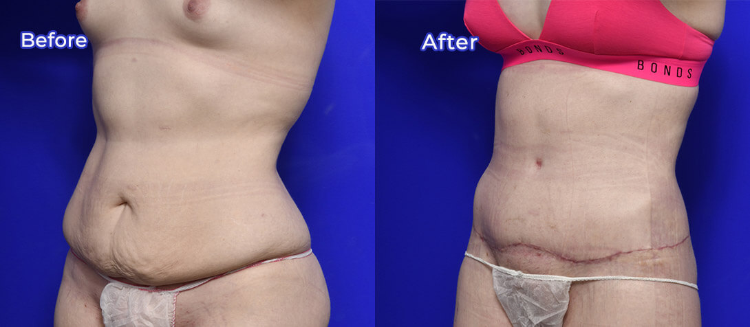 Patient before and after tummy tuck surgery, photo 06