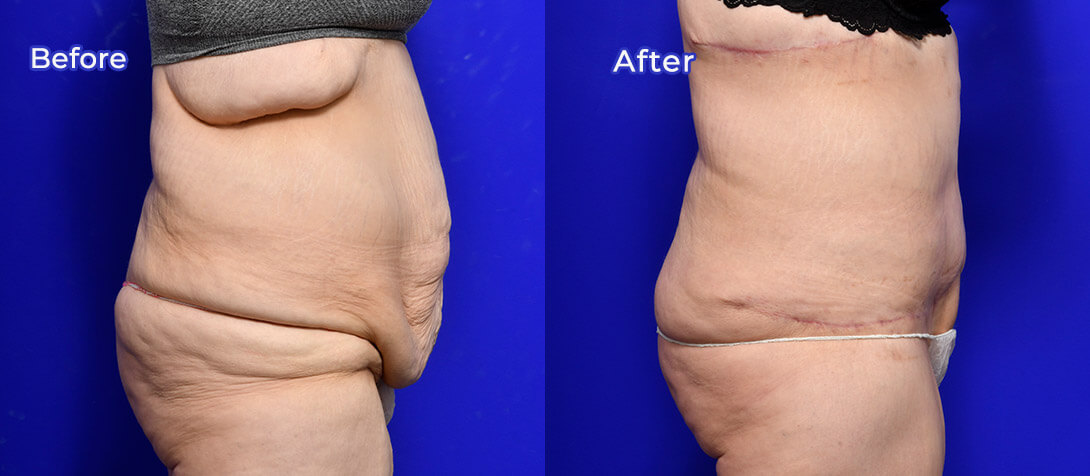 Tummy tuck patient before & after 07, Ritz Plastic Surgery