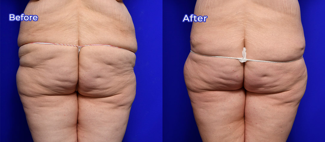 Abdominoplasty gallery, photo 08