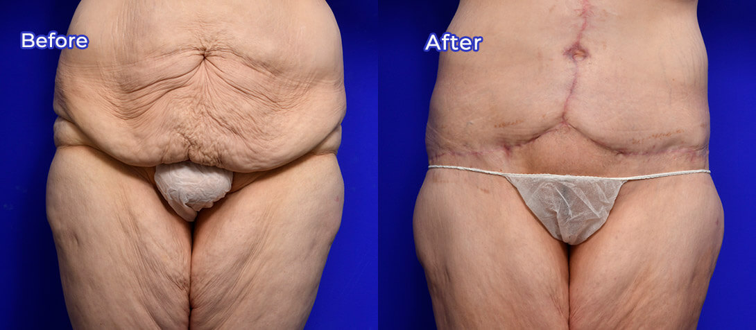 Tummy tuck photo 09, image gallery