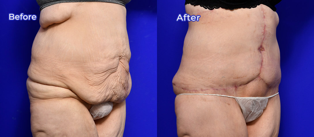 Tummy tuck photo 10, Ritz Plastic Surgery