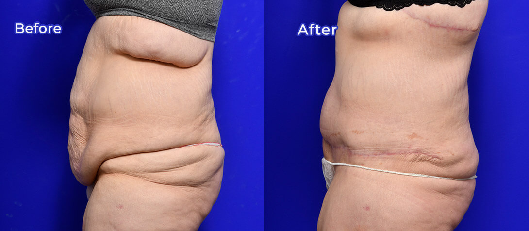 Abdominoplasty before and after 11, Dr Ritz