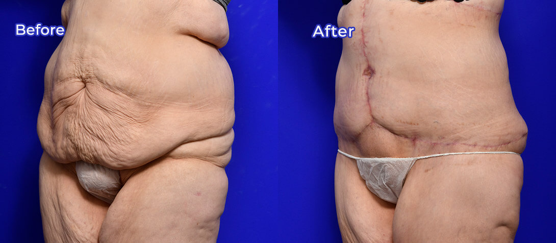 Tummy tuck surgery 12, before & after gallery