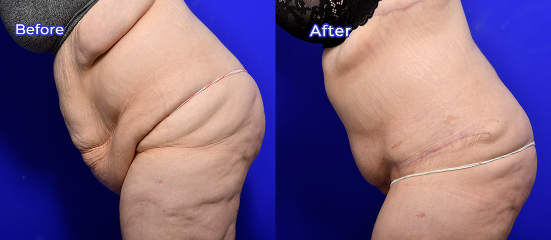 Abdominoplasty patient before and after surgery 13