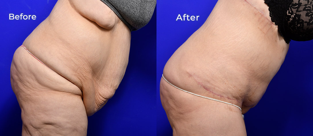 Tummy tuck before and after 14 (abdominoplasty), Ritz Plastic Surgery