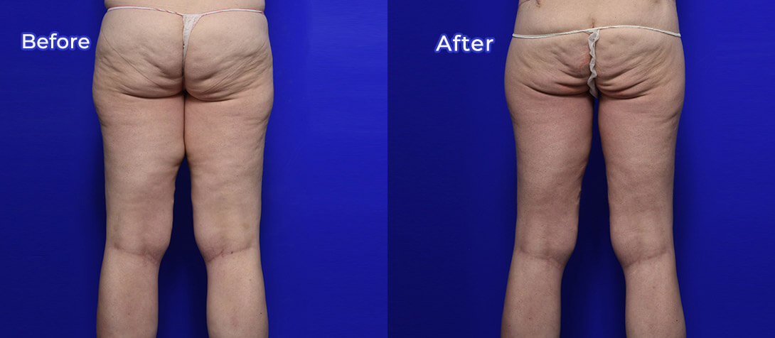 Patient before and after thigh lift 01, Dr Ritz