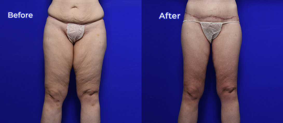 Thigh lift patient before and after 02, Dr Ritz Malvern, Melbourne