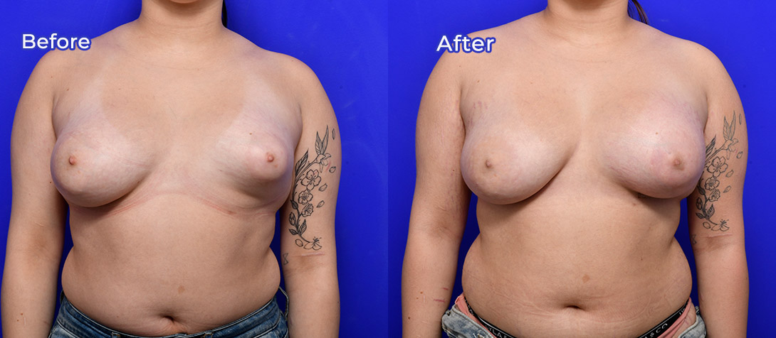Breast asymmetry 01a, patient before & after, front view