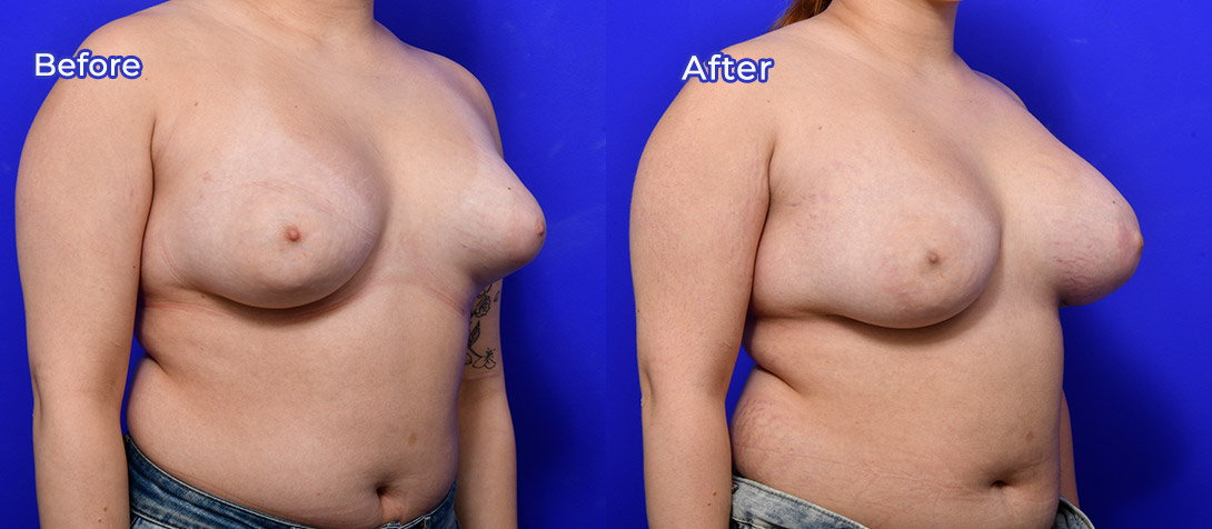 Patient before and after breast asymmetry correction surgery 01b