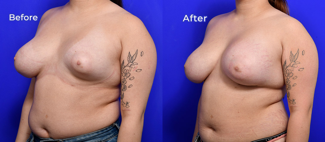 Breast asymmetry surgery 01c, Ritz Plastic Surgery, angle view