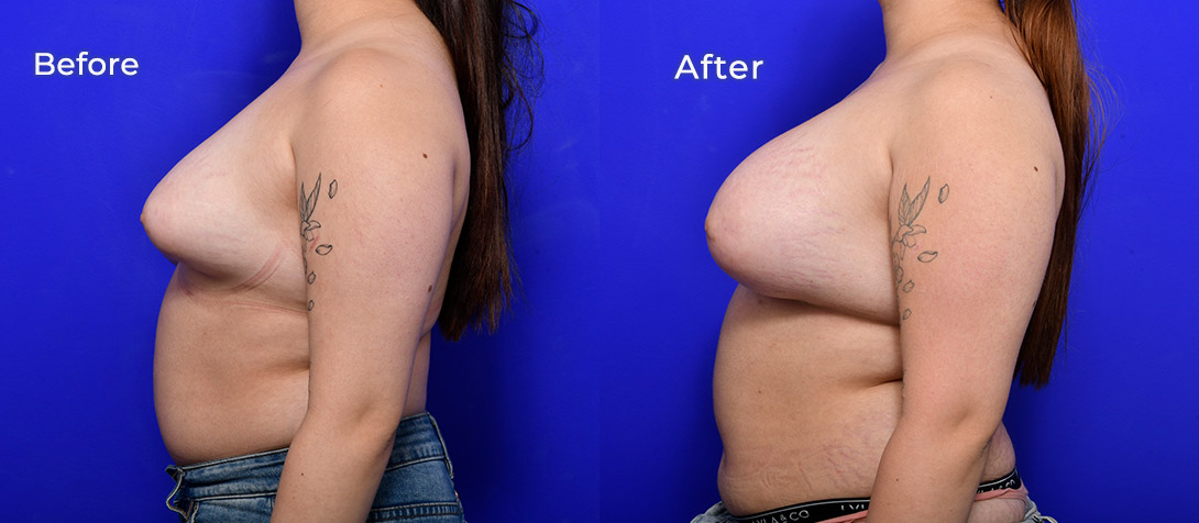 A patient before and after breast asymmetry surgery, photo 01d