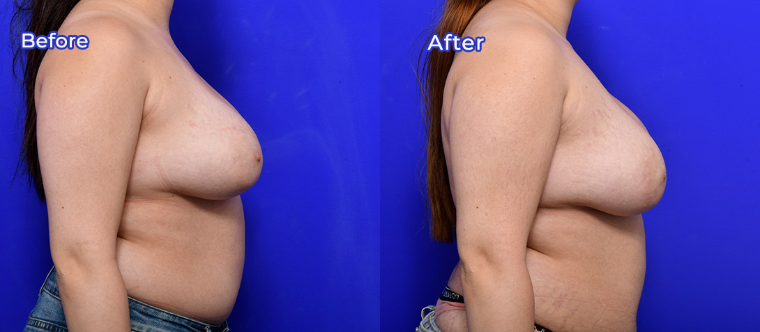 Breast asymmetry correction patient, photo 01e, before & after