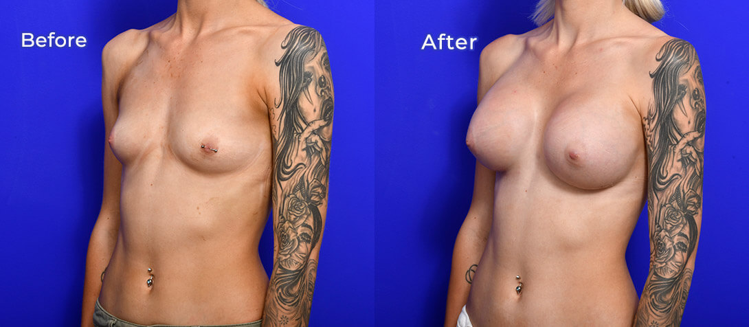 Breast implants, patient before & after, 01d, angle view