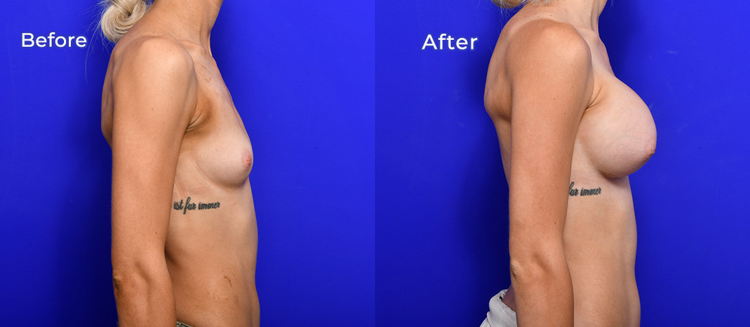 Breast implants surgery, Dr Ritz, patient before & after, side view